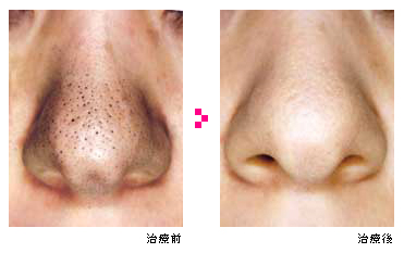 ライトプリペア 症例写真
