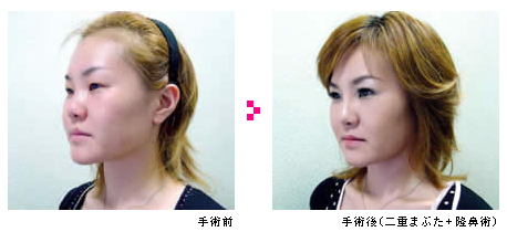 隆鼻術の症例写真 手術前/手術後