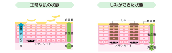 しみ・そばかす 発症のメカニズム