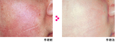 赤ら顔治療